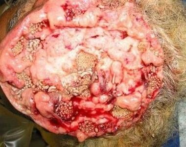 parasitas no cérebro humano